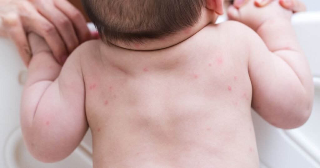 How to Treat Heat Rash on Baby