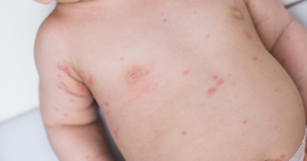 How to Treat Heat Rash on Baby