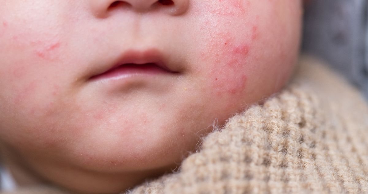 How to Treat Heat Rash on Baby